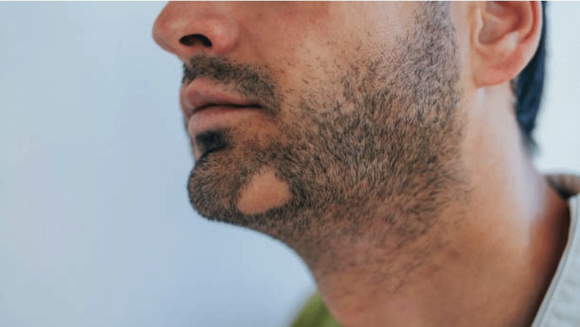 Alopecija areata na bradi