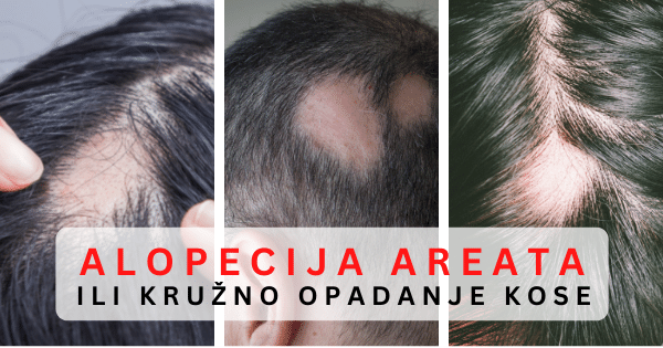 Opadanje kose i alopecija areata