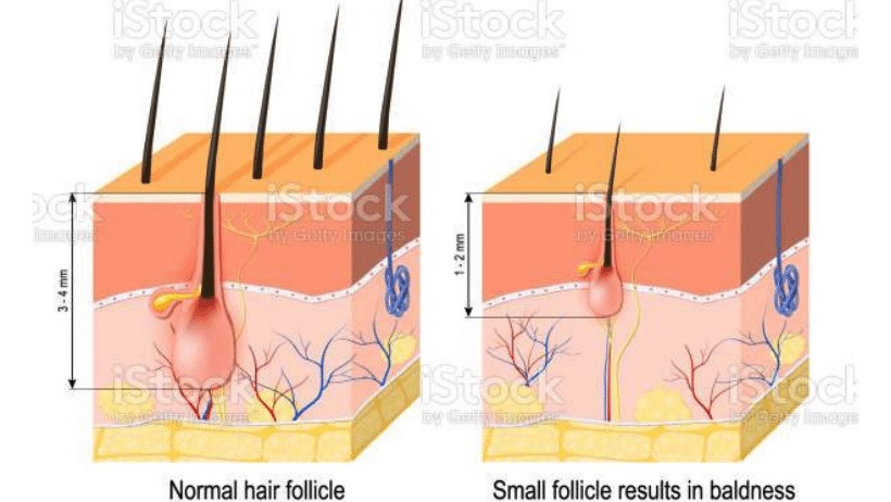 Hair loss after corona