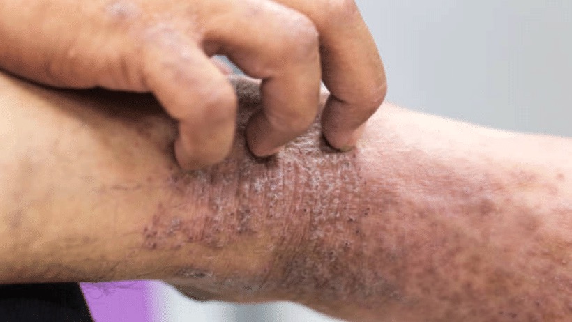 التهاب الجلد | أنواع التهاب الجلد