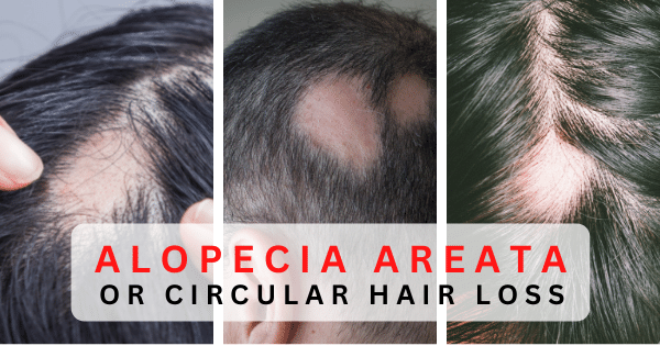 Circular hair loss and alopecia areata