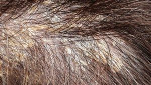 Dermatitis