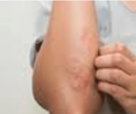 Eczema feautered image
