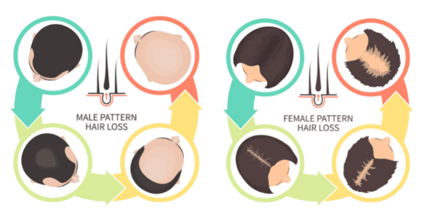 Hereditary hair loss (androgenic alopecia)