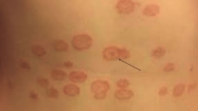 Pelle con infezione da tigna (Tinea corporis)