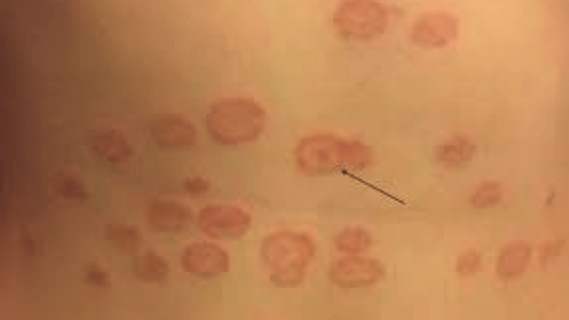 Tinea corporis (ringworm)