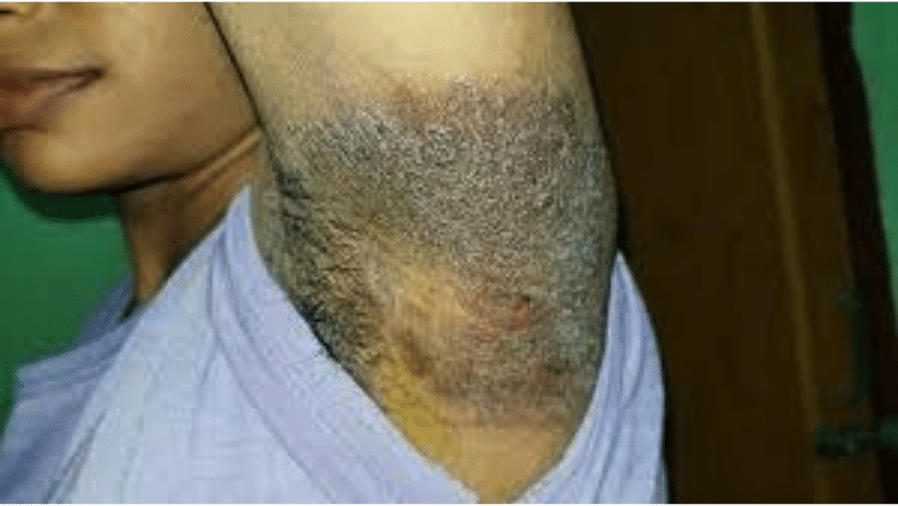 Ringworm  What is it? Symptoms and signs !