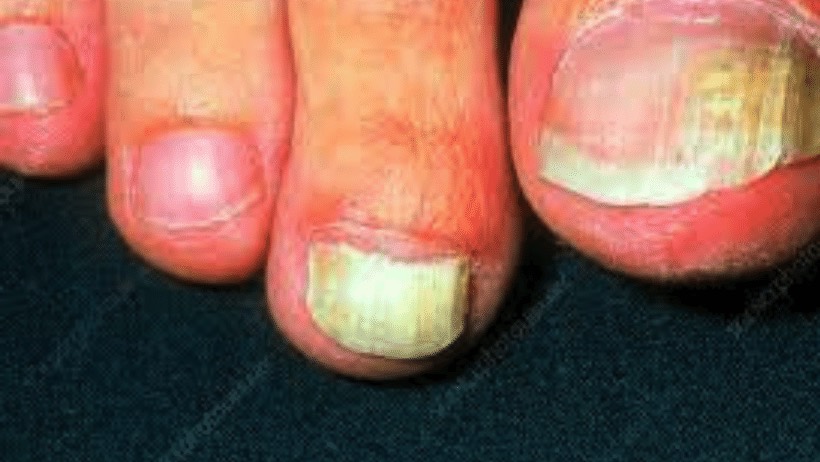 Lišajevi na noktima