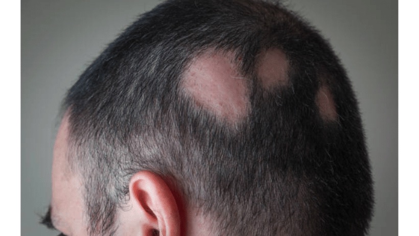 Alopecija areata