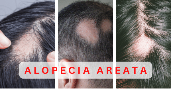 Caduta dei capelli e alopecia areata
