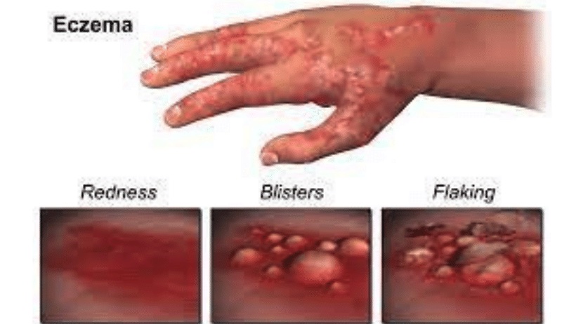 Eczema Eczema what does it look like symptoms and causes 