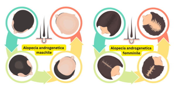 Perdita di capelli ereditaria (alopecia androgenetica)