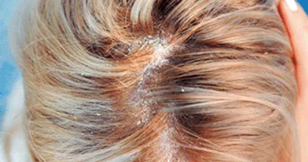 Central part of the scalp