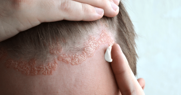 Eczema: symptoms, causes and treatments