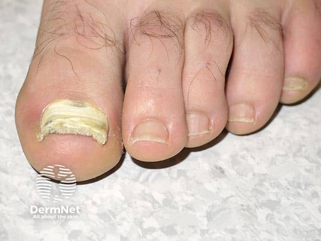 Lišaji na nohtih (Tinea Unguium)
