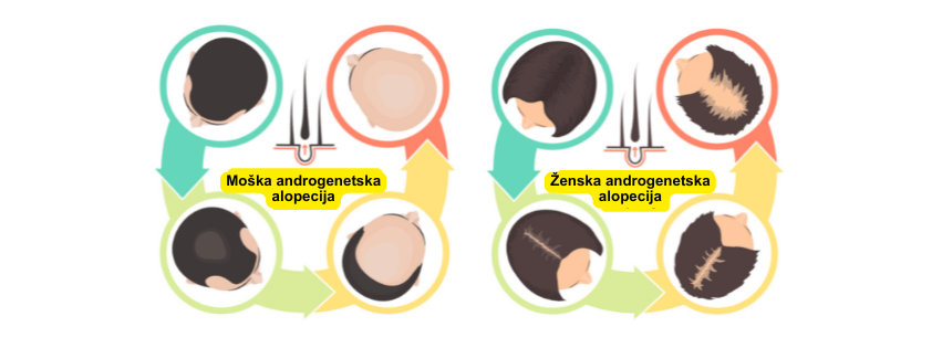 Razvoj androgenetske alopecije